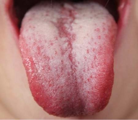 Removes Candida from tongue